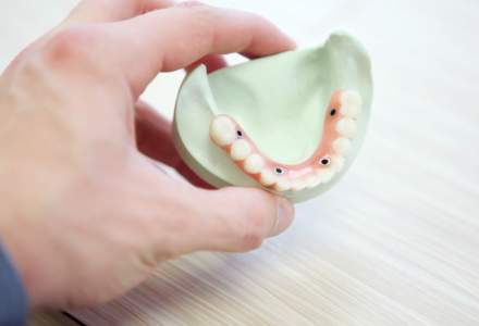 Implanturile dentare, o piata de 107 milioane de euro in 2020. Numarul romanilor care le solicita s-a triplat in ultimii doi ani