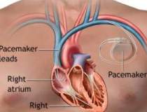 Inventie elvetiana: pacemaker...