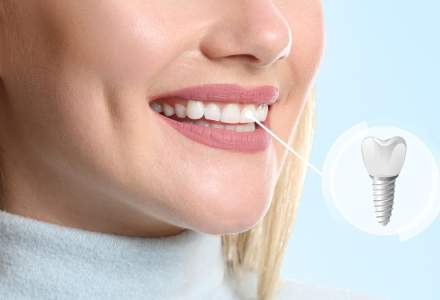Implanturile dentare în era digitală - o soluție rapidă și eficientă pentru un zâmbet perfect