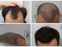 Dr. Felix Hair Implant:...