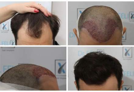 Implant sau transplant de păr prin tehnica FUE avansat, vezi detalii despre Dr. Felix Hair Implant
