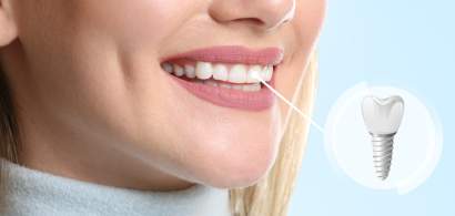 Implanturile dentare în era digitală - o soluție rapidă și eficientă pentru...