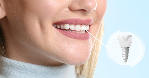 Implanturile dentare în era digitală - o soluție rapidă și eficientă pentru...