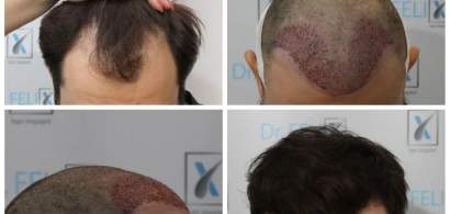 Implant sau transplant de păr prin tehnica FUE avansat, vezi detalii despre...