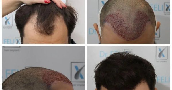 Implant sau transplant de păr prin tehnica FUE avansat, vezi detalii despre...