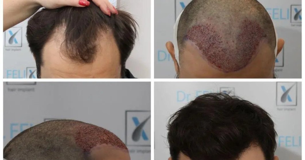 Implant sau transplant de păr prin tehnica FUE avansat, vezi detalii despre Dr. Felix Hair Implant
