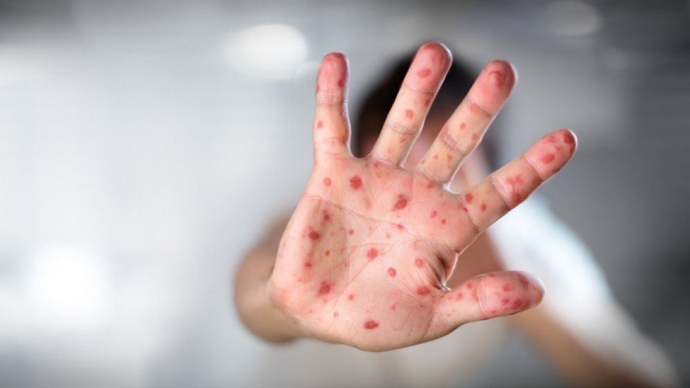 Ministerul Sănătății anunță că în România s-a declanșat epidemia de rujeolă