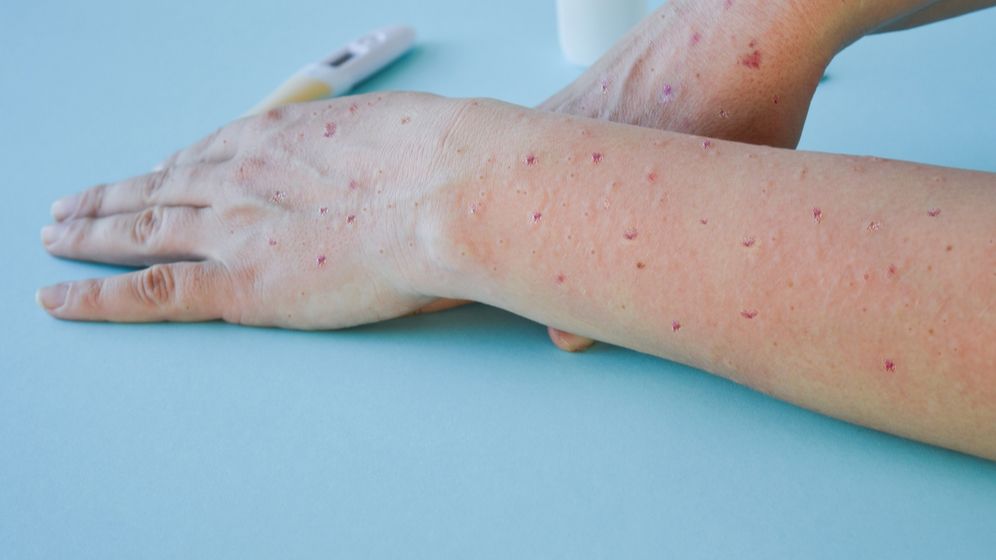 Variola maimuței: ce este, care sunt simptomele și cum ne putem proteja de infecție