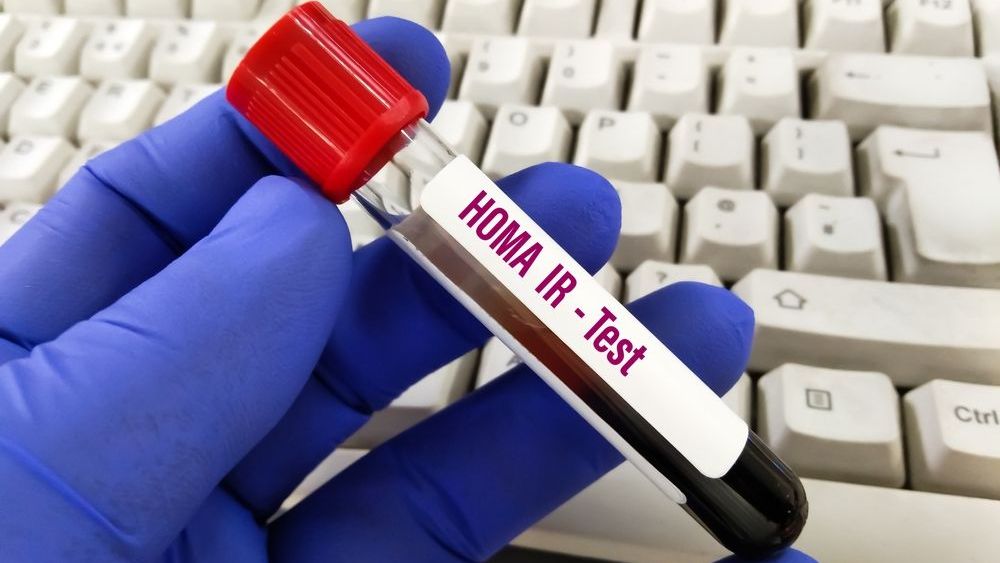 Indicele HOMA: ce este și ce trebuie să știi