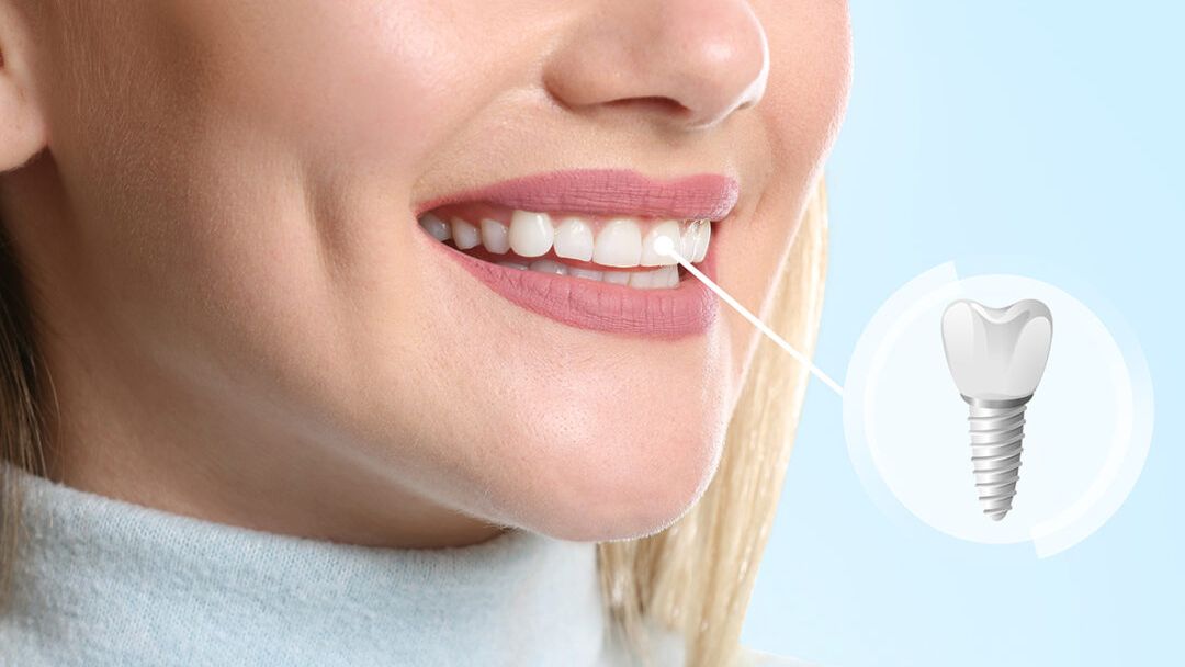 Implanturile dentare în era digitală - o soluție rapidă și eficientă pentru un zâmbet perfect