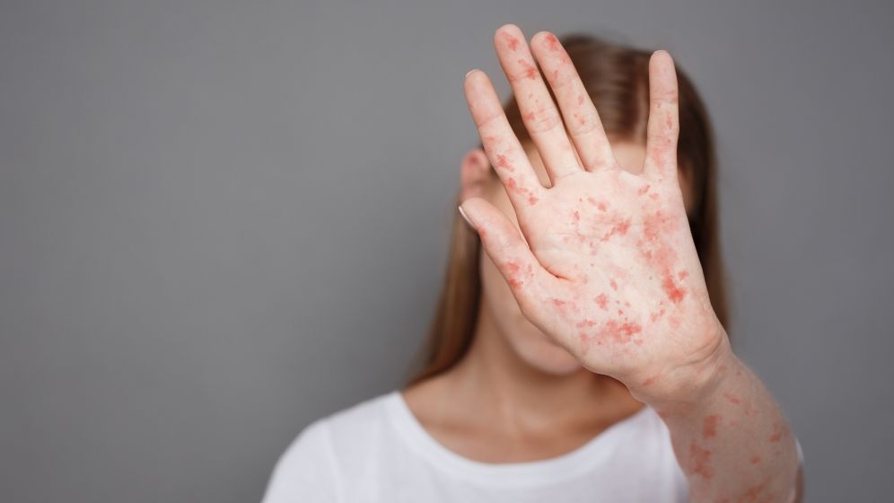 INSP: 41 de noi cazuri de rujeolă - confirmate în România în ultima săptămână