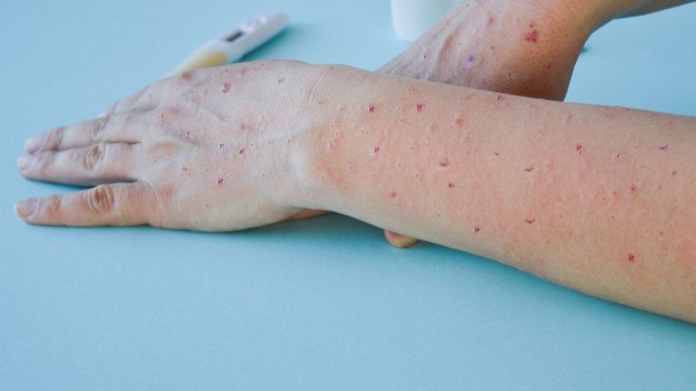 Primele decese la bolnavi de variola maimuței în Europa