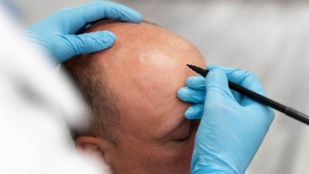 Implant de păr și preț estimativ. Între imagine personală și cum influențează performanța în afaceri