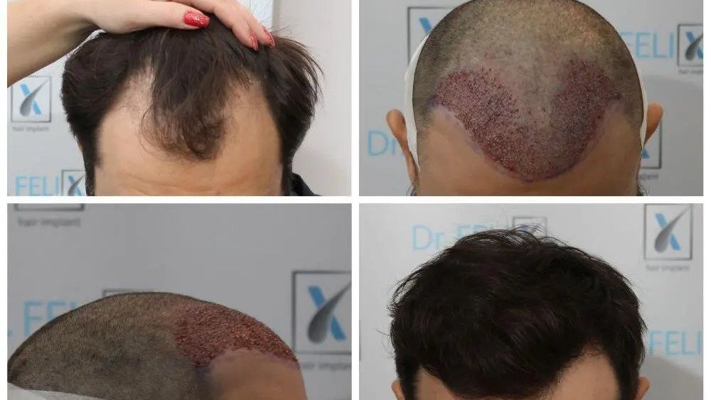 Implant sau transplant de păr prin tehnica FUE avansat, vezi detalii despre Dr. Felix Hair Implant